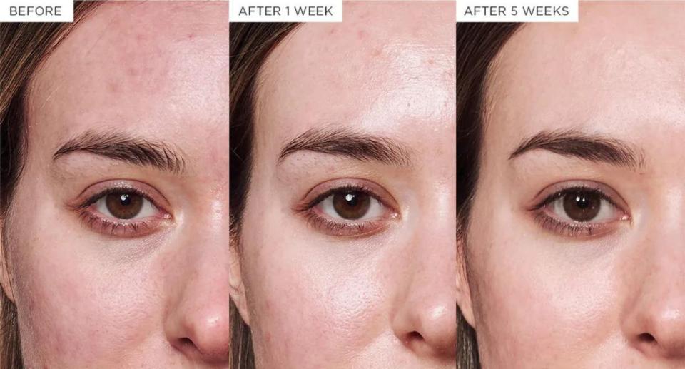 Glow Recipe has proven the effectiveness of the Avocado Soothing Skin Barrier Serum with impressive before and after shots like the one above. Testers saw significant results after one week of using the serum and even better results after five weeks. 