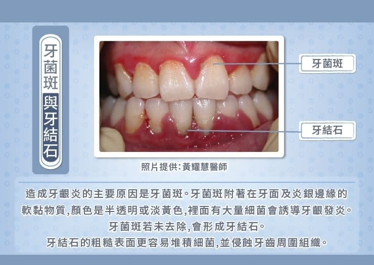 牙齦炎放著不管恐掉牙