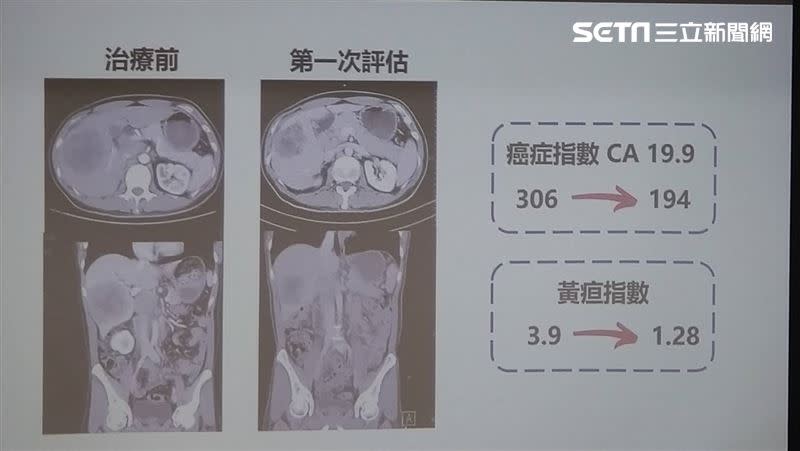 膽道癌病友劉先生使用免疫療法與化療後，癌指數和黃疸指數都明顯改善（圖／記者黃仲丘攝影）