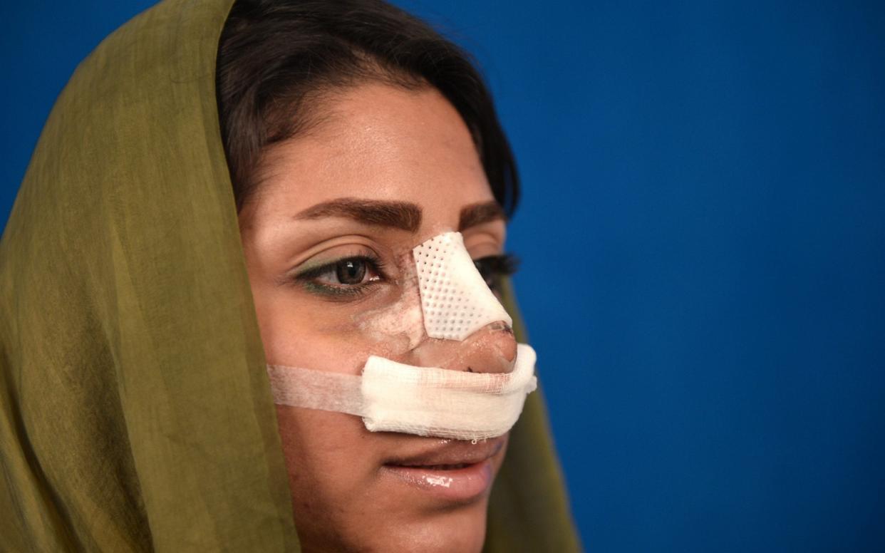 Cosmetic surgery, including rhinoplasty, is popular with many Iranian women - Anadolu