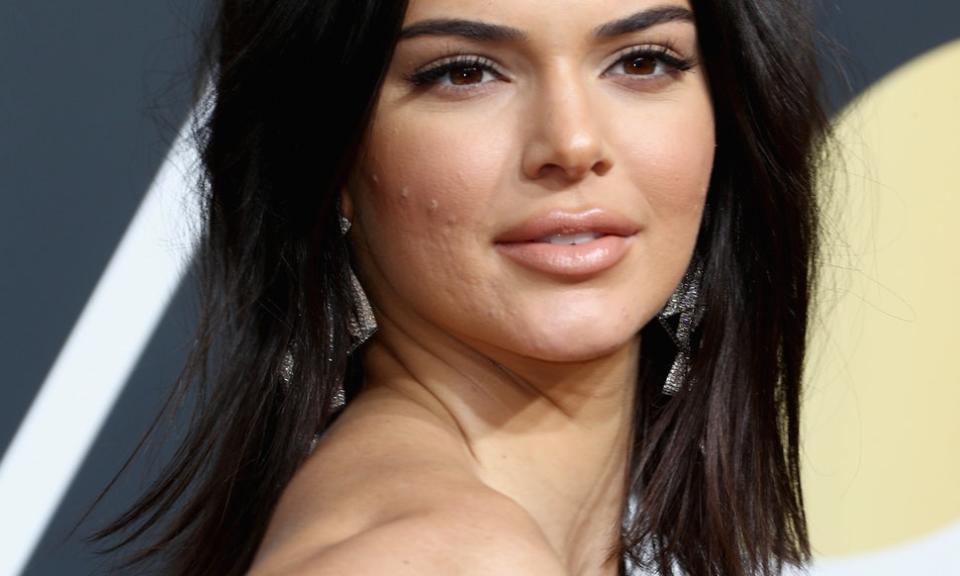 Famosas como Kendall Jenner han reconocido tener este problema y usan las redes sociales para normalizarlo bajo el hashtag<a href="https://www.instagram.com/explore/tags/skinpositivity/?hl=es" rel="nofollow noopener" target="_blank" data-ylk="slk:#skinpositivity.;elm:context_link;itc:0;sec:content-canvas" class="link "><em> #skinpositivity.</em></a> (Foto: Getty)