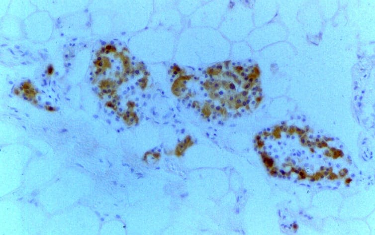 <span class="caption">Fibrous deposits in pancreas due to cystic fibrosis.</span> <span class="attribution"><a class="link " href="https://wellcomecollection.org/works/sbbr52xk?query=cystic+fibrosis" rel="nofollow noopener" target="_blank" data-ylk="slk:Anne Clark, University of Oxford/Wellcome Collection;elm:context_link;itc:0;sec:content-canvas">Anne Clark, University of Oxford/Wellcome Collection</a>, <a class="link " href="http://creativecommons.org/licenses/by/4.0/" rel="nofollow noopener" target="_blank" data-ylk="slk:CC BY;elm:context_link;itc:0;sec:content-canvas">CC BY</a></span>