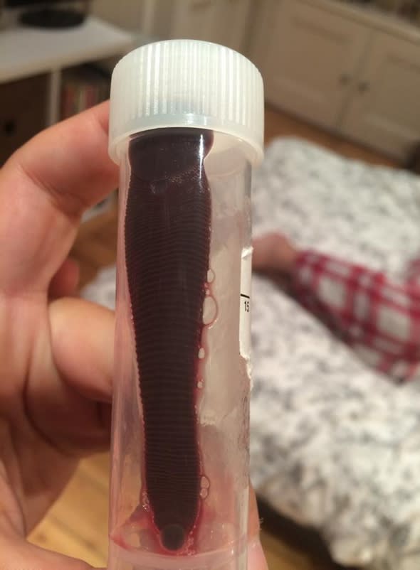 British backpacker has three-inch leech up nose for a month