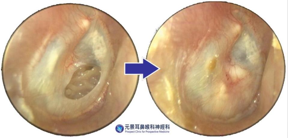 左圖為原本之右側耳膜穿孔；右圖為接受耳膜成形術後，耳膜穿孔痊癒。（醫師陳建志提供）