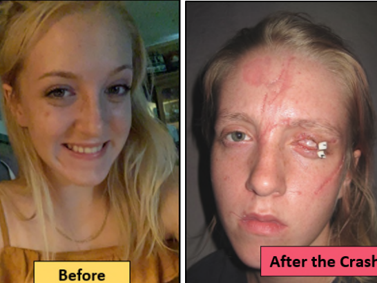 Sara Mae Morgan, before and after a 2020 accident that involved a defective passenger air bag in a Ford Mustang.