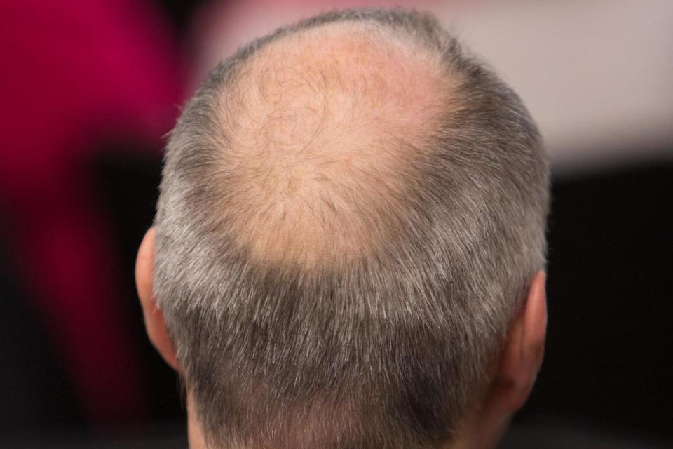 Male pattern baldness affects the majority of men over 50 (Garo/Phanie/Shutterstock)