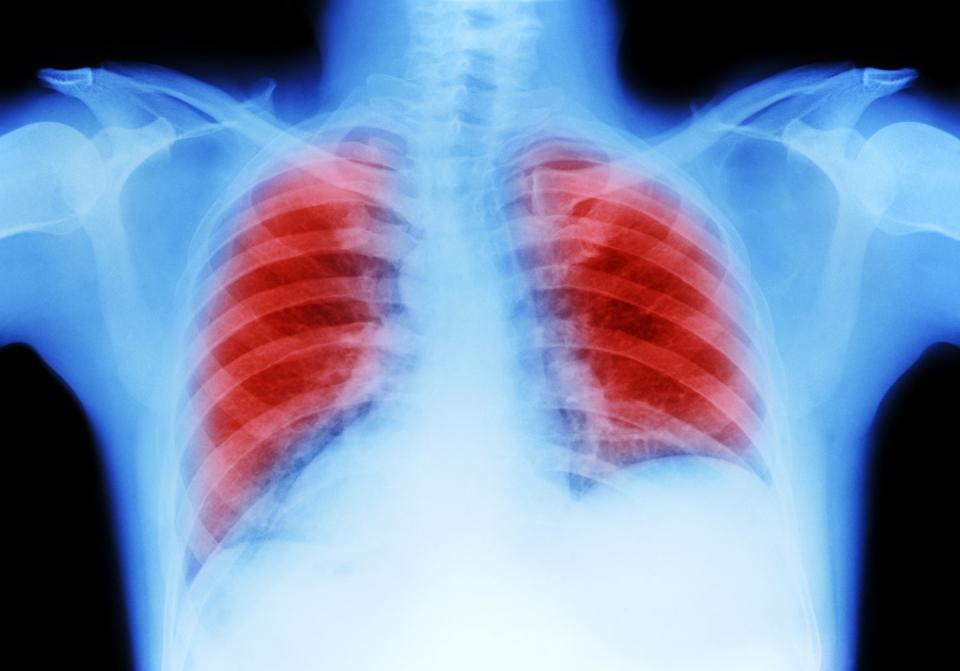 lung cancer chest x ray