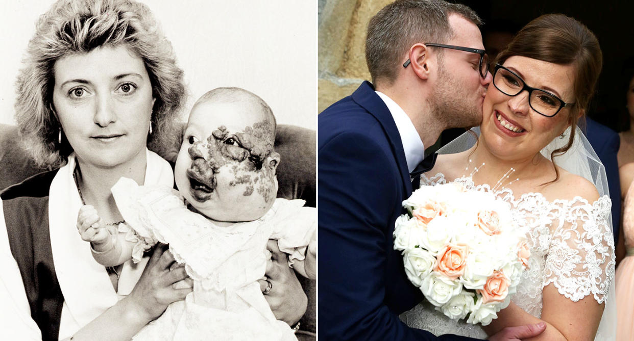 A bride who was born with a facial deformity got her happily ever after when she married her long-term partner. (Photo: SWNS)