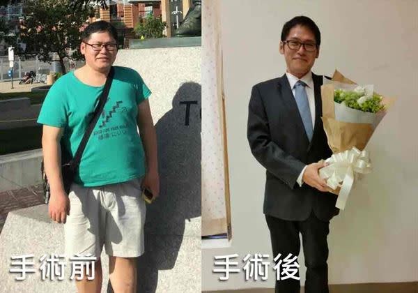 現年35歲的呂先生身高171公分，在前年體重仍有102公斤，且被檢查出有糖尿病，由於藥物控制效果始終不佳。再經過胃縮小手術後1年，體重終於減至69公斤，實現嚮往已久的健康生活。（圖片提供／黃致錕院長）