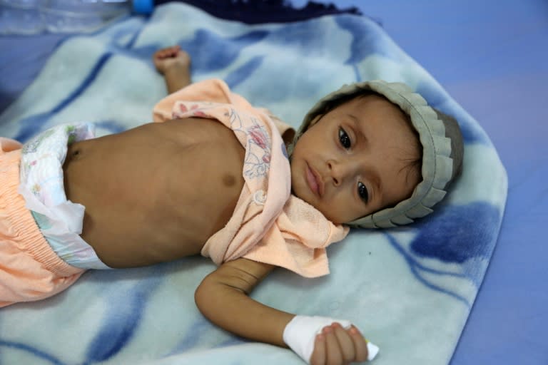 A malnourished Yemeni child receives treatment at a hospital in the Yemeni port city of Hodeidah on December 3, 2017