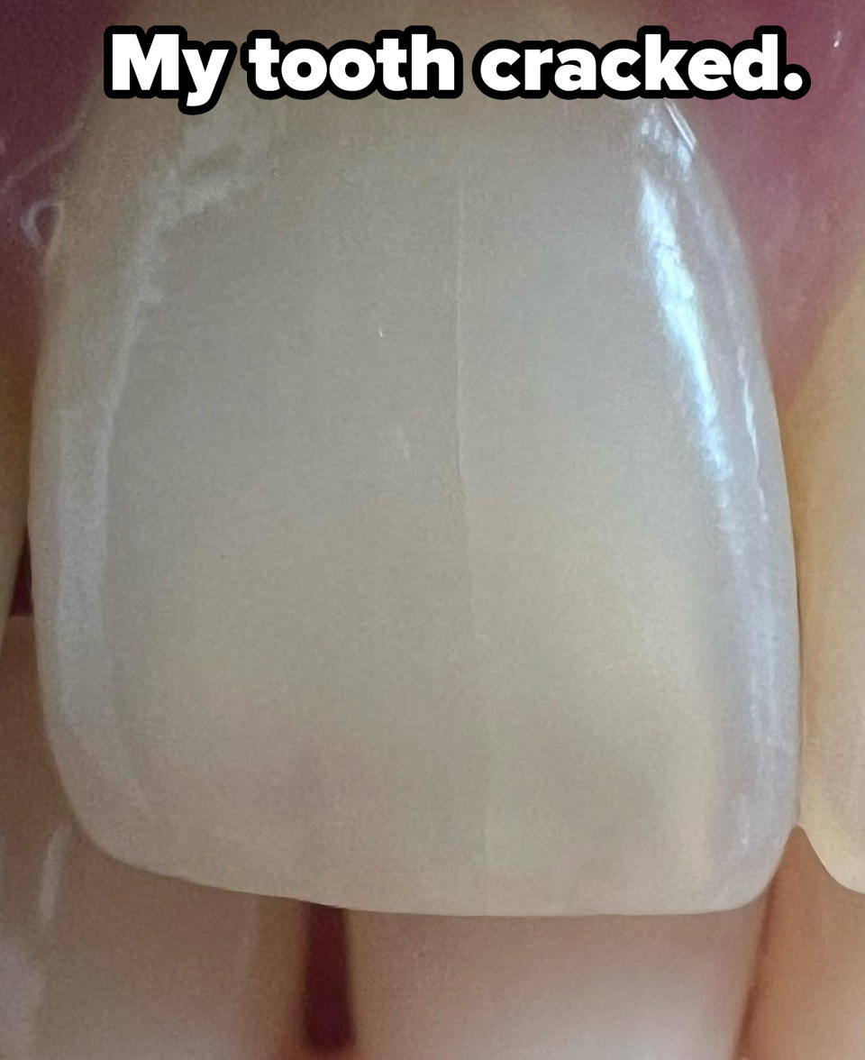 A close-up image of a person's front tooth, showing a vertical crack running down the center