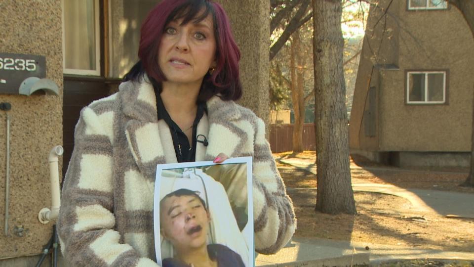 Edmonton defence lawyer Heather Steinke-Attia displays a photo of her client, Pacey Dumas, taken shortly after he was injured during an arrest.