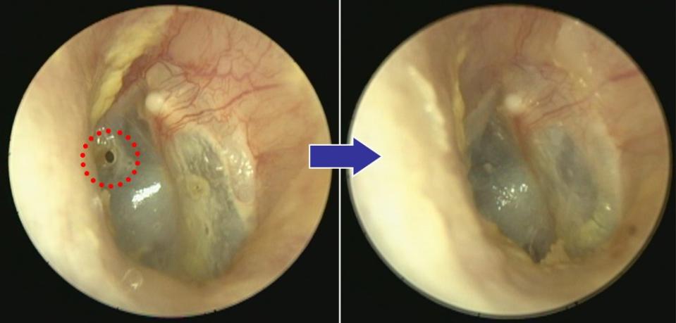 左圖呈現患者耳膜上有一個小洞 （紅色圈）；右圖係經過治療後，耳膜穿孔已癒合。（陳建志醫師提供）