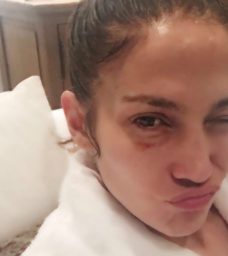 Being an actress certainly isn't an easy job! It looks like Jennifer Lopez had a rough day at work as she showed off her black eye after a long day filming her show "Shades of Blue." "Sometimes work can be rough...lol," the actress and singer captioned the selfie of her new injury from Nov. 30, 2016.