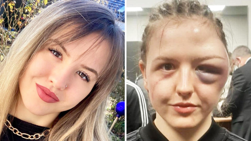 Cheyenne Hanson (pictured left) taking a photo and (pictured right) after a head injury.