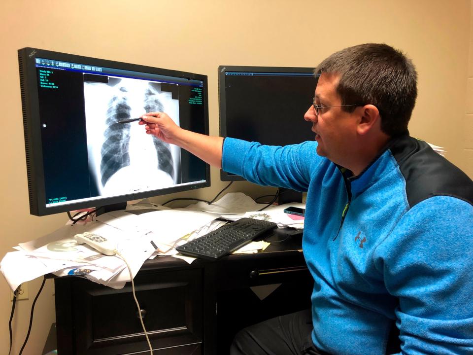 Dr. Brandon Crum points to the X-ray of a black lung patient at his office in Pikeville, Ky., on Thursday, Jan. 24, 2019. Crum has seen a wave of younger miners with black lung disease at his clinic since 2015. (AP Photo/Dylan Lovan) ORG XMIT: RPDL102