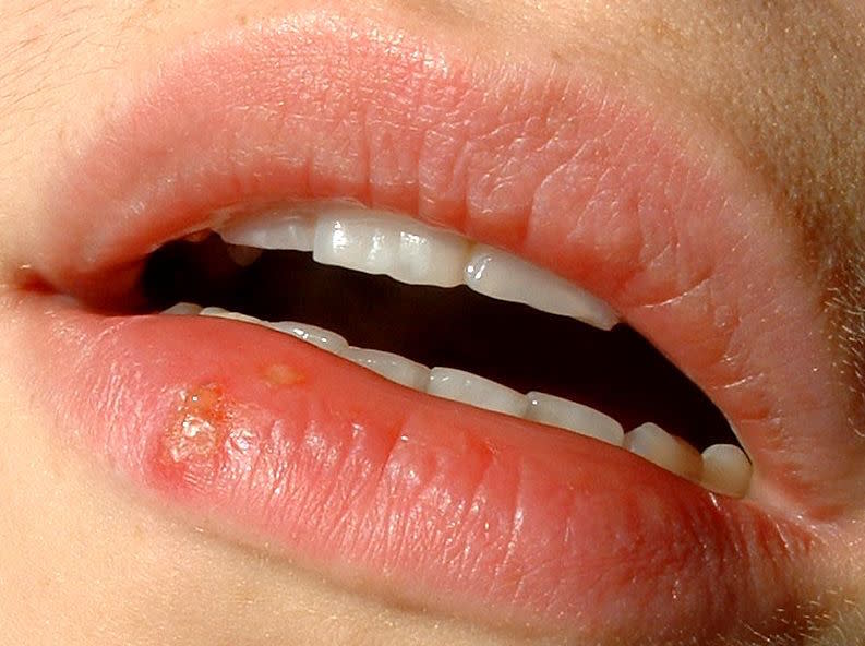 Are Cold Sores Herpes? The Difference Between HSV-1 and HSV-2
