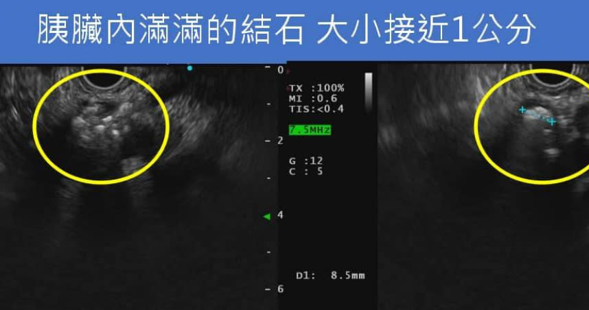 一名50歲男姓年輕時為了工作經常應酬，經超音波檢查發現胰臟已經萎縮。（圖／翻攝自胰臟醫師 林相宏 禾馨民權內科診所臉書）