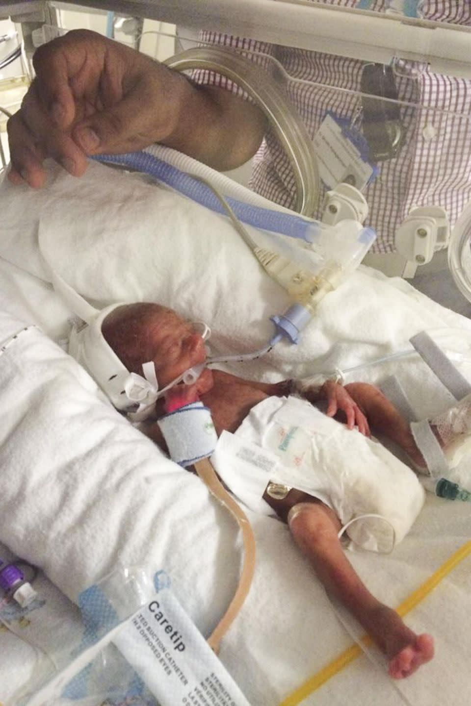 Casey, who is now 18-months-old, was delivered by emergency C-section just five months into the pregnancy and began life without a heartbeat, not breathing and the size of a small bottle of Coke. Photo: Caters News