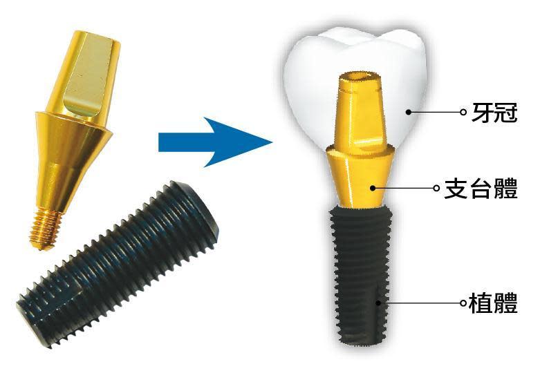 人工牙根（左）是以醫療級鈦金屬製成，透過手術植入齒槽骨，待骨整合後再安裝牙冠（右），滿足患者咀嚼及美觀需求。（右圖翻攝鴻君科技官網）