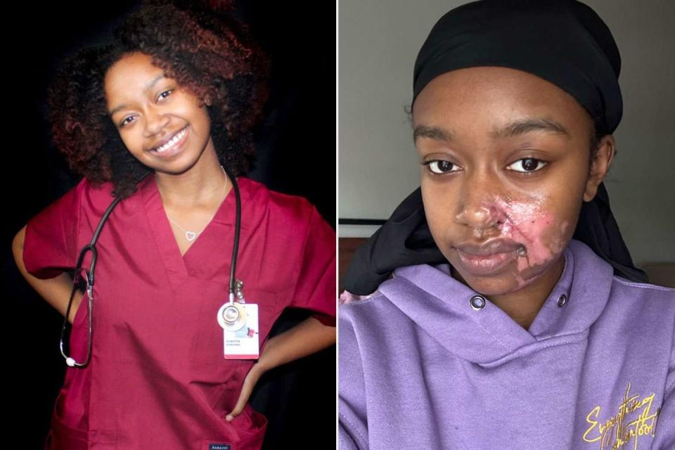 <p>Credit: Juanita Jimenez</p> Juanita Jimenez before and after she was attacked with acid