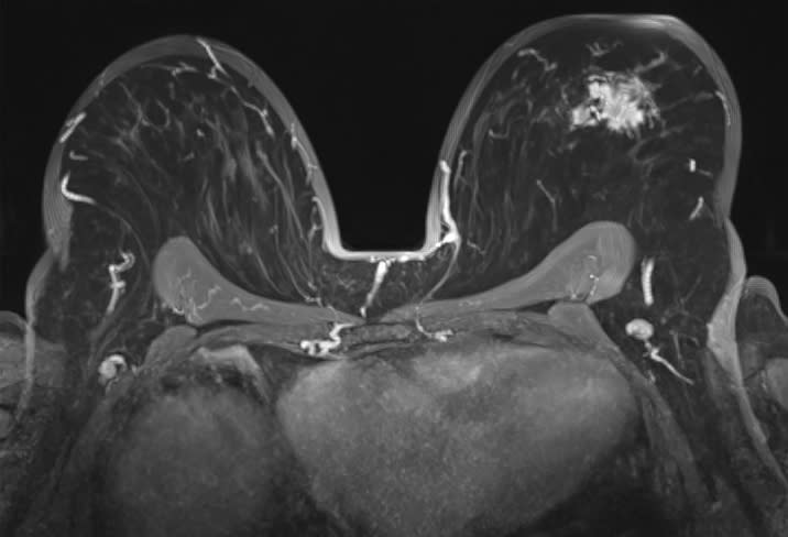 Resonancia magnética (MRI), cuándo se utiliza para explorar los senos