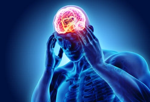 <span class="caption">Attacks can last from 15 minutes to a couple of hours, several times a day.</span> <span class="attribution"><a class="link " href="https://www.shutterstock.com/image-illustration/3d-illustration-headache-human-xray-medical-1007012911" rel="nofollow noopener" target="_blank" data-ylk="slk:MDGRPHCS/ Shutterstock;elm:context_link;itc:0;sec:content-canvas">MDGRPHCS/ Shutterstock</a></span>