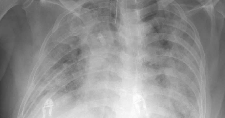 北市聯醫陽明院區胸腔內科主治醫師蘇一峰6日在臉書發文透露，一名從中國回來的台商確診，演變成嚴重肺炎，X光照片可以看到變成了「大白肺」。（圖／翻攝蘇一峰臉書）