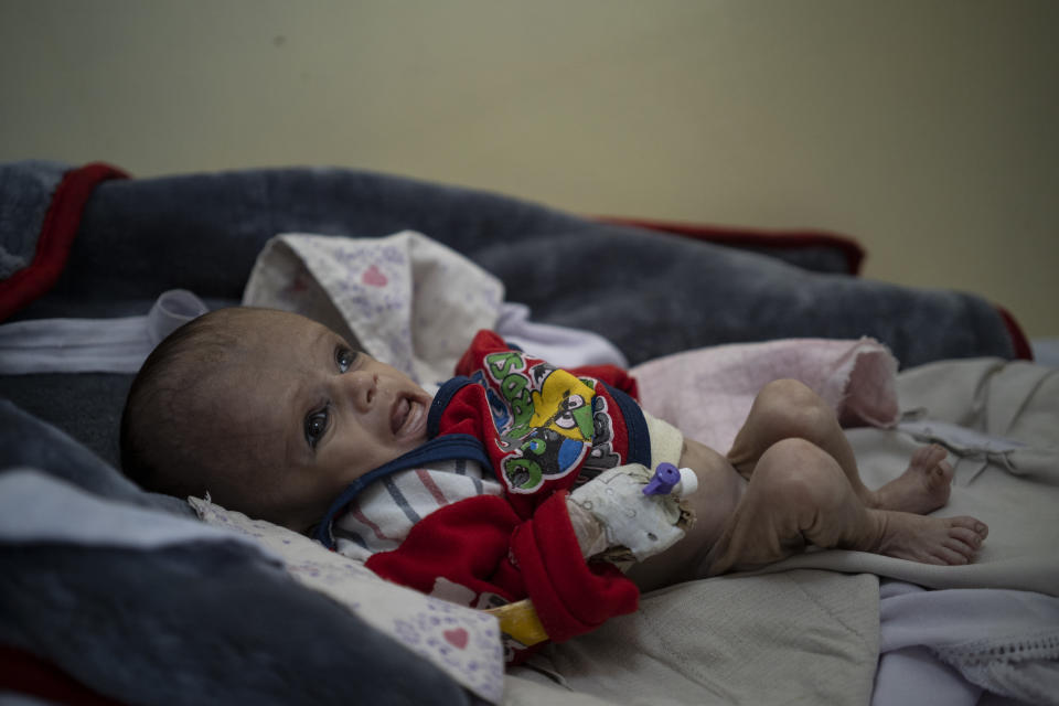 Mohammed, 4 years old, who is malnourished, lays on a hospital bed in the Indira Gandhi hospital in Kabul, Afghanistan on Monday, Nov. 8, 2021. The number of people living in Afghanistan in near-famine conditions has risen to 8.7 million according to the World Food Program. (AP Photo/Bram Janssen)