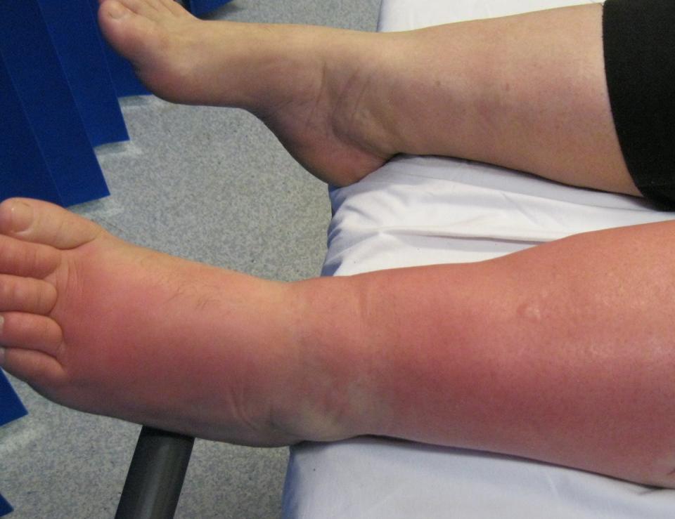 <span class="caption">The reddish pink rash spreads quickly.</span> <span class="attribution"><a class="link " href="https://www.flickr.com/photos/104346167@N06/44699141152/" rel="nofollow noopener" target="_blank" data-ylk="slk:jlcampbell104/Flickr;elm:context_link;itc:0;sec:content-canvas">jlcampbell104/Flickr</a></span>