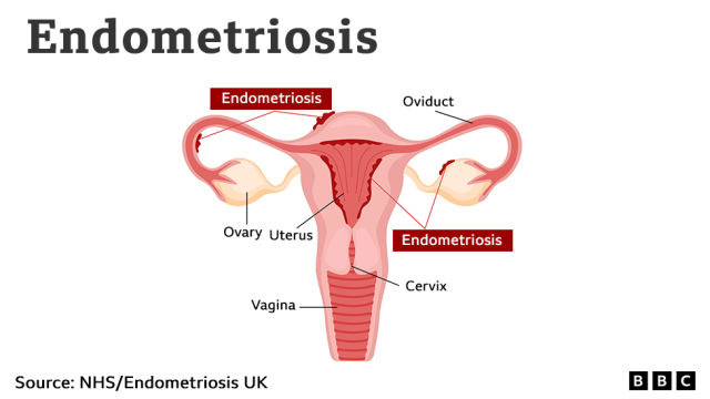 Endometriosis: Women in Wales waiting 10 years for diagnosis