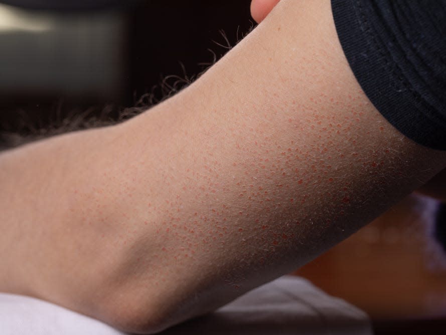 Keratosis Pilaris skin bumps