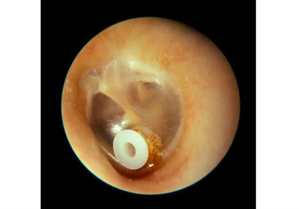 置入「中耳通氣管」平衡內外壓力並可協助排除中耳積水。（圖片／溫明勳醫師提供）