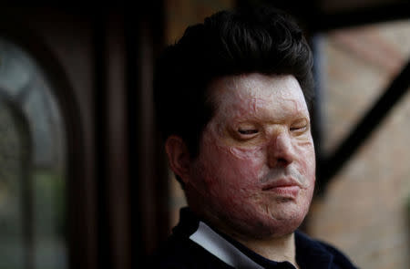 Acid attack victim Andreas Christopheros, poses for a photograph in his home in Truro, south-west England, Britain July 31, 2017. REUTERS/Peter Nicholls