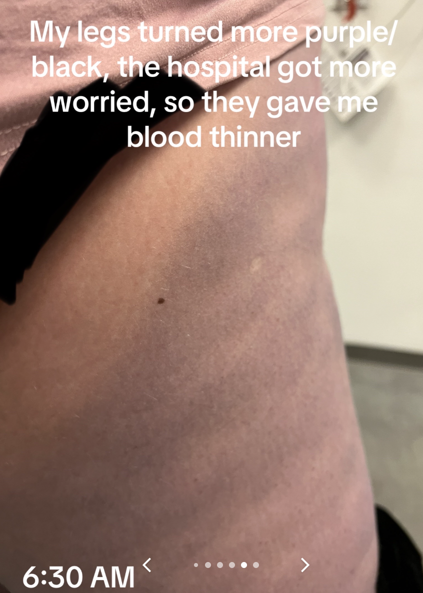 Person's leg with bruises and text: "My legs turned more purple/black, the hospital got more worried, so they gave me blood thinner"