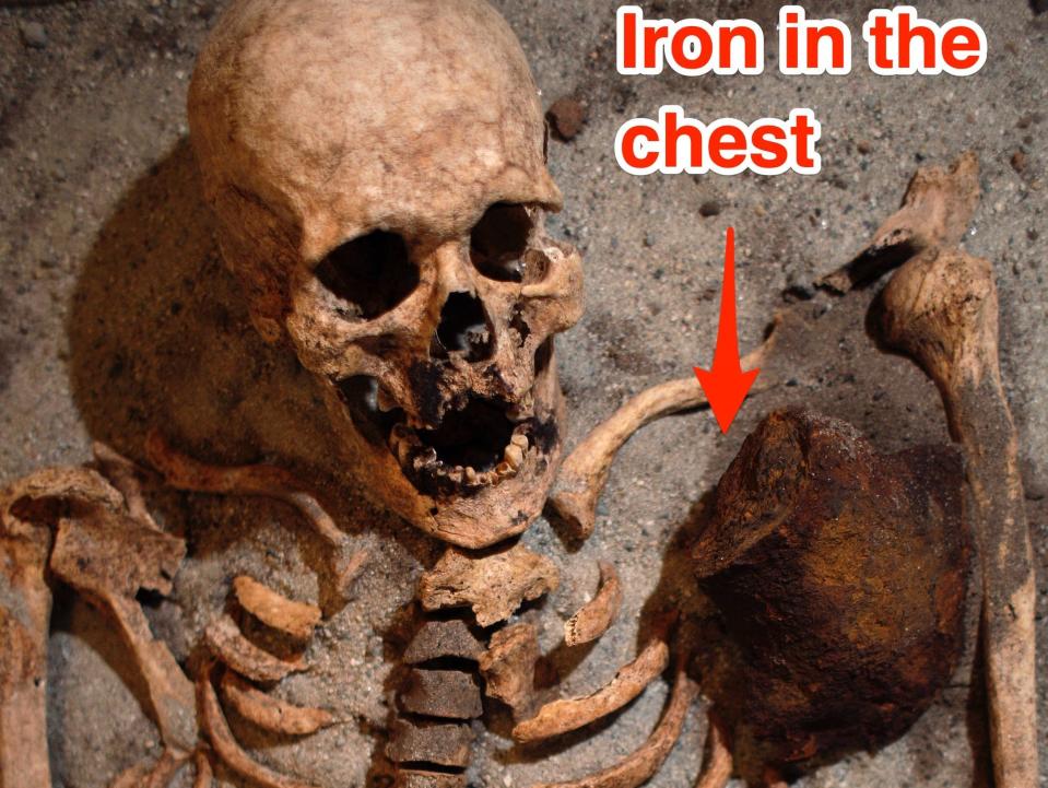 An aged skeleton is seen with a large block of iron placed near its chest under the armpit.