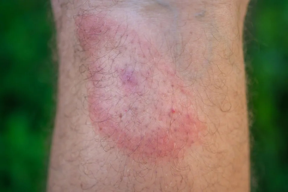 tick bite symptoms bullseye rash