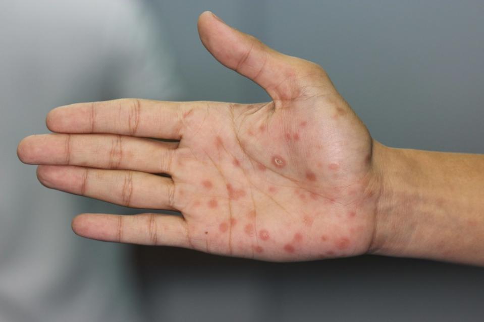 Syphilis sores are painless, meaning they often go untreated. 4-10 weeks after infection, a rash often develops across a sufferer’s body. nuengneng – stock.adobe.com