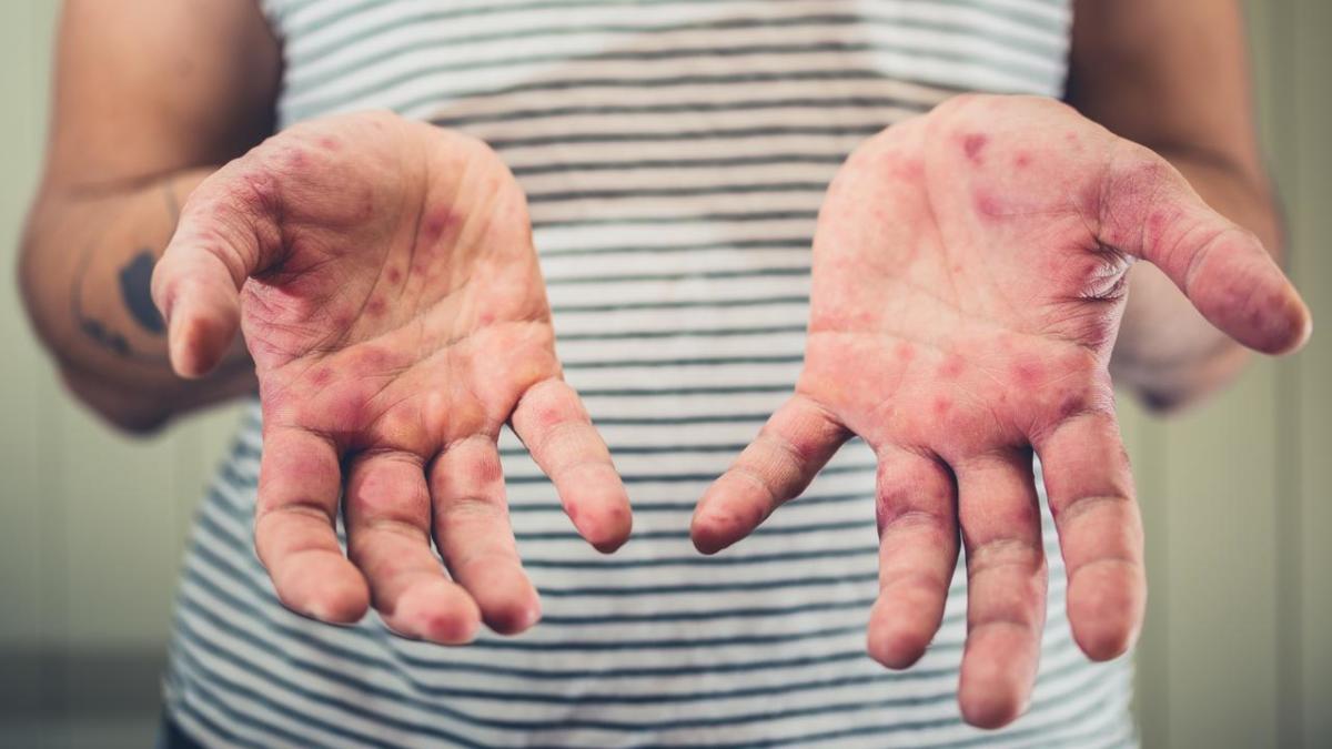 Un cas de rougeole déclenche une alerte sanitaire majeure