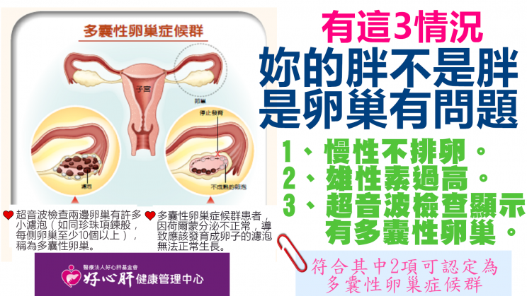 多囊性卵巢症候群