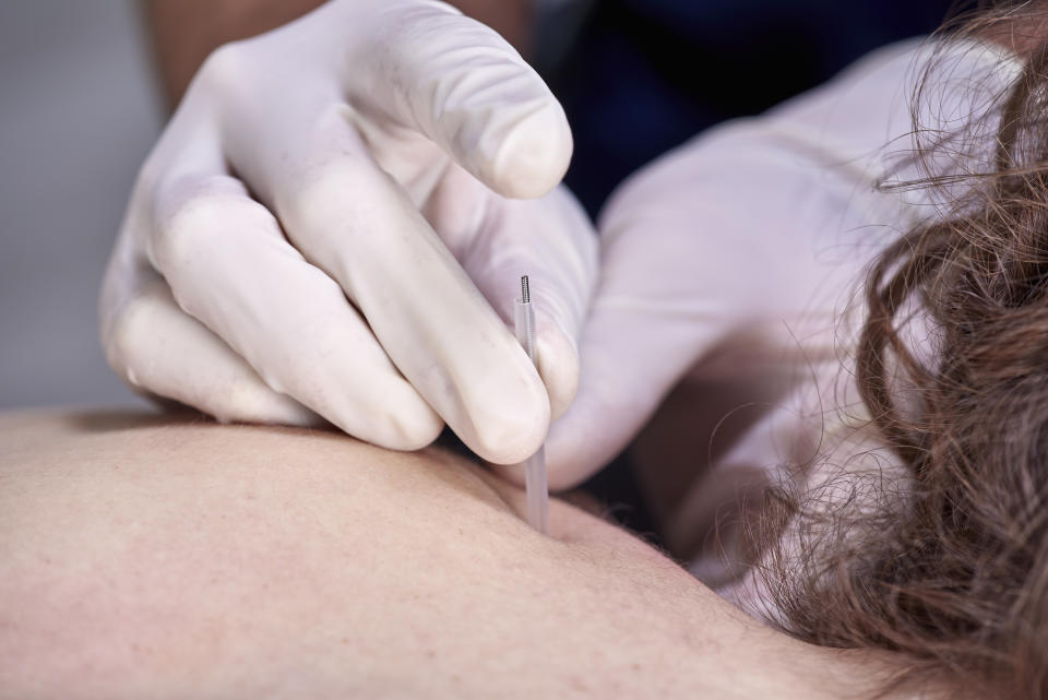 Chiropractor doing dry needling, closeup of a needle and hands. Physiotherapist, osteopath, manual therapy, acupressure. Acupuncture, alternative medicine.