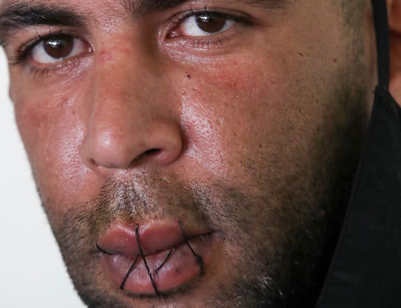 Mohamed Lamine, an asylum seeker, is seen with his lips sewed together, in Brussels