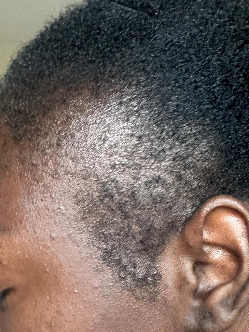 Close-up of Ashley Parker’s hairline in October 2023.