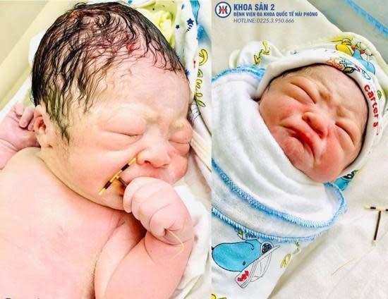 越南一個男寶寶驚奇出生，手還握著媽媽當年裝的避孕器，掀起關注。（翻攝自Facebook）