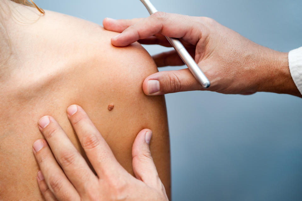 Mole check up. (Getty Images)