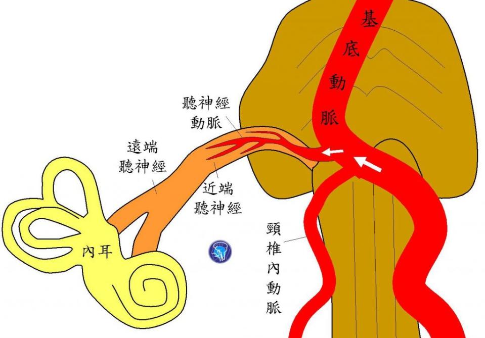椎基底動脈擴大扭曲，大量來自頸椎內動脈的血流，直接灌入聽神經動脈，就會出現搏動性耳鳴。　（醫師陳建志提供）