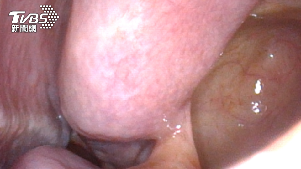 男子手術後鼻竇內視鏡。（圖／北市聯醫提供）