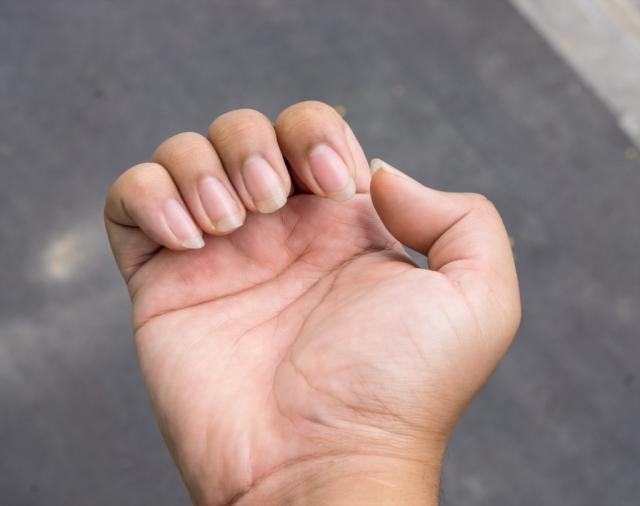 5 Ways Your Hands Are Telling You That Your Liver's in Trouble