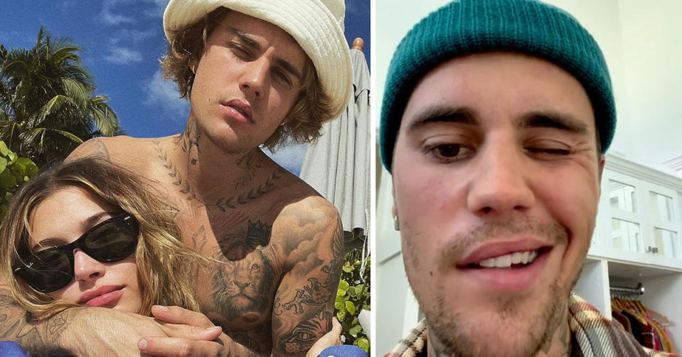 Left: Justin Bieber with a hat hugging wife Hailey Bieber who is wearing sunglasses. Right: Justin Bieber demonstrates how he can't move one side of his face.