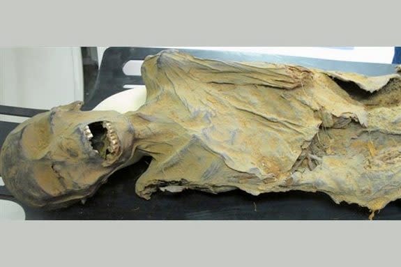 A CT scan of a mummified, mid-forties woman who lived in what is now Peru between 1100 and 1800 years ago revealed evidence of narrowed arteries.